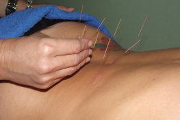 zabieg akupunktury