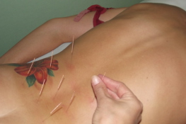 zabieg akupunktury